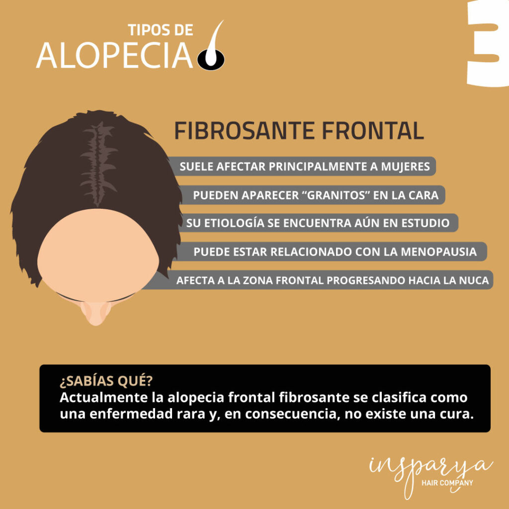 alopecia fibrosante frontal