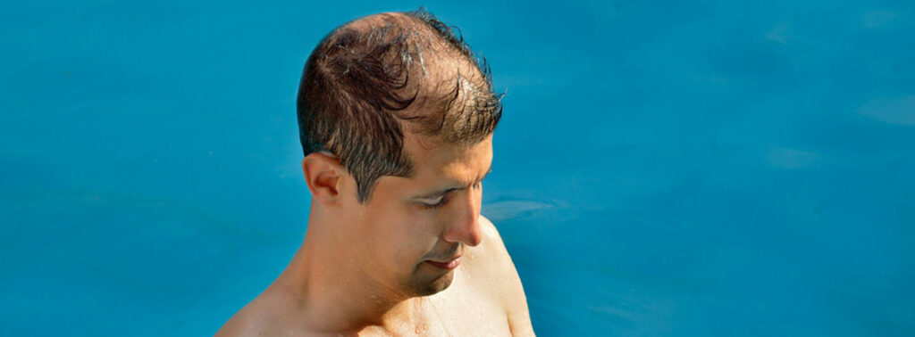 la calvicie es un factor de riesgo para el cáncer de piel