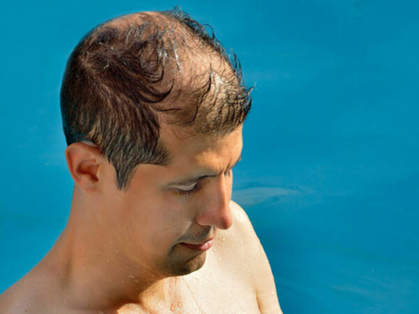 la calvicie es un factor de riesgo para el cáncer de piel