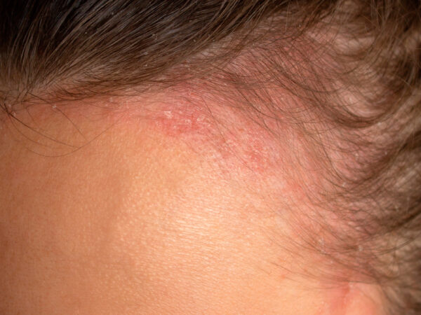 Dermatitis seborreica: por qué reaparece y qué hacer para mantenerla bajo control 