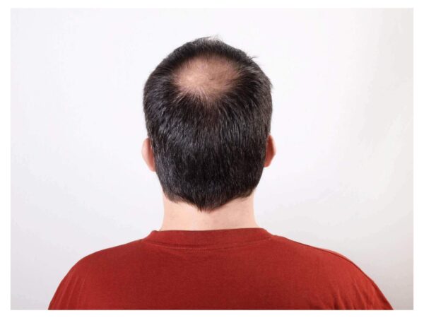 Home remedies for alopecia or hair loss
