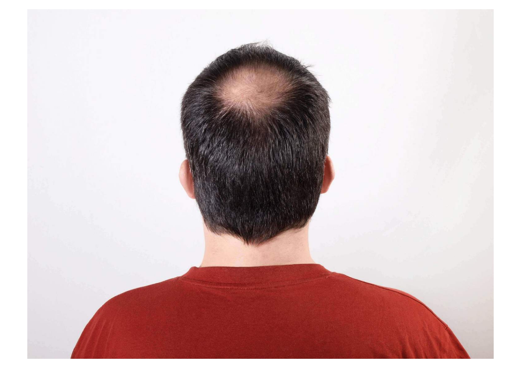 How to stop balding naturally increase