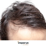 Alopecia y envejecimiento prematuro