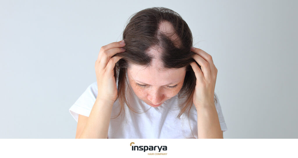 alopecia in women