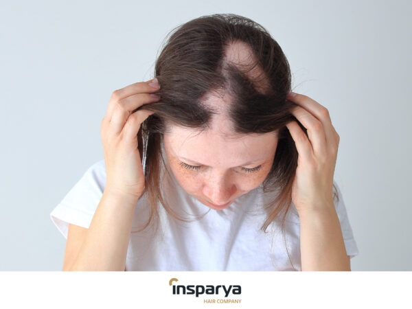 alopecia in women