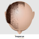 types of alopecia