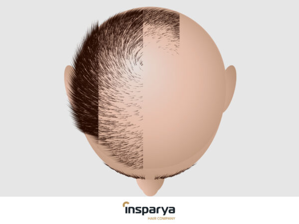 types of alopecia