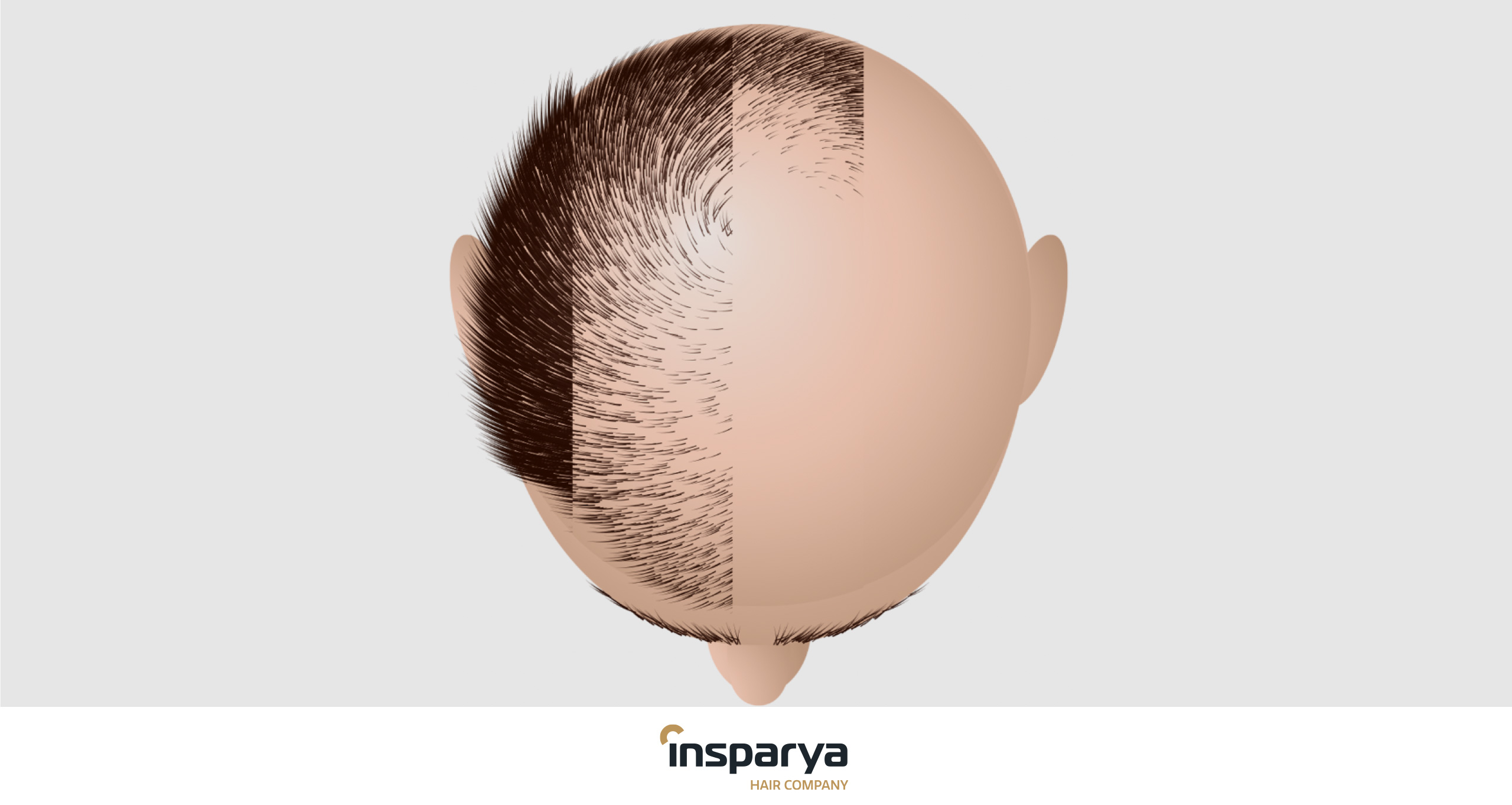 Types of alopecia | Insparya Hair Clinic