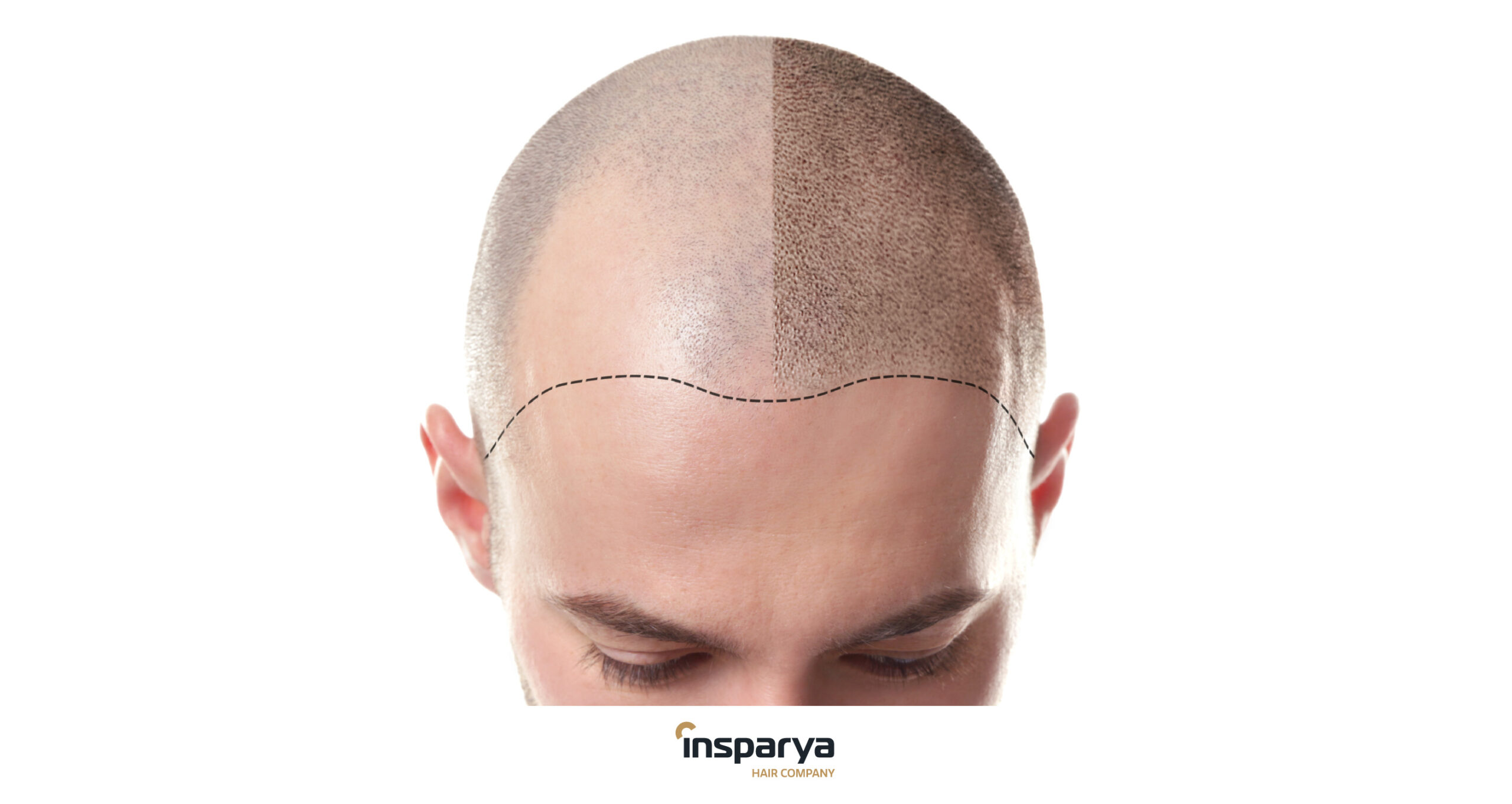 hair transplantation