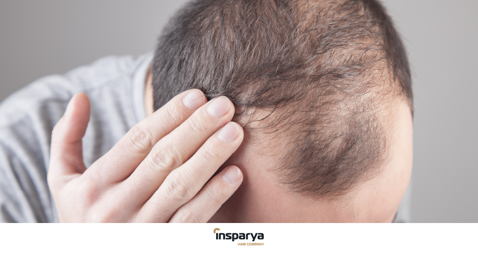 Som svar på universitetsområde skygge Minoxidil: what it is for and its side effects | Insparya Hair Clinic