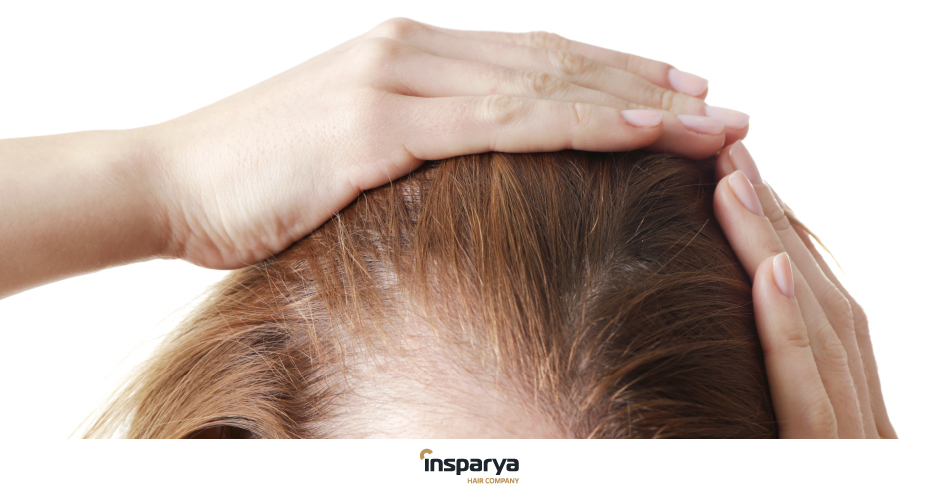 Female alopecia: Everything you need to know | Insparya