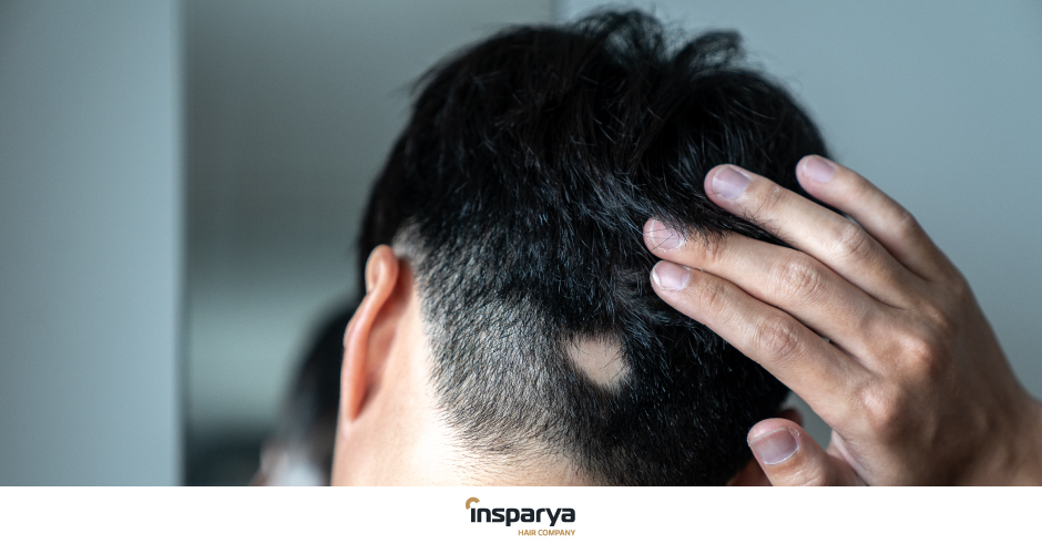 Alopecia areata | Insparya Hair Clinic
