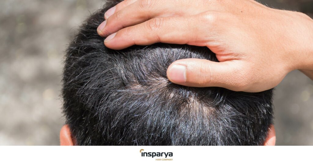 Can Graves Disease Cause Itchy Scalp