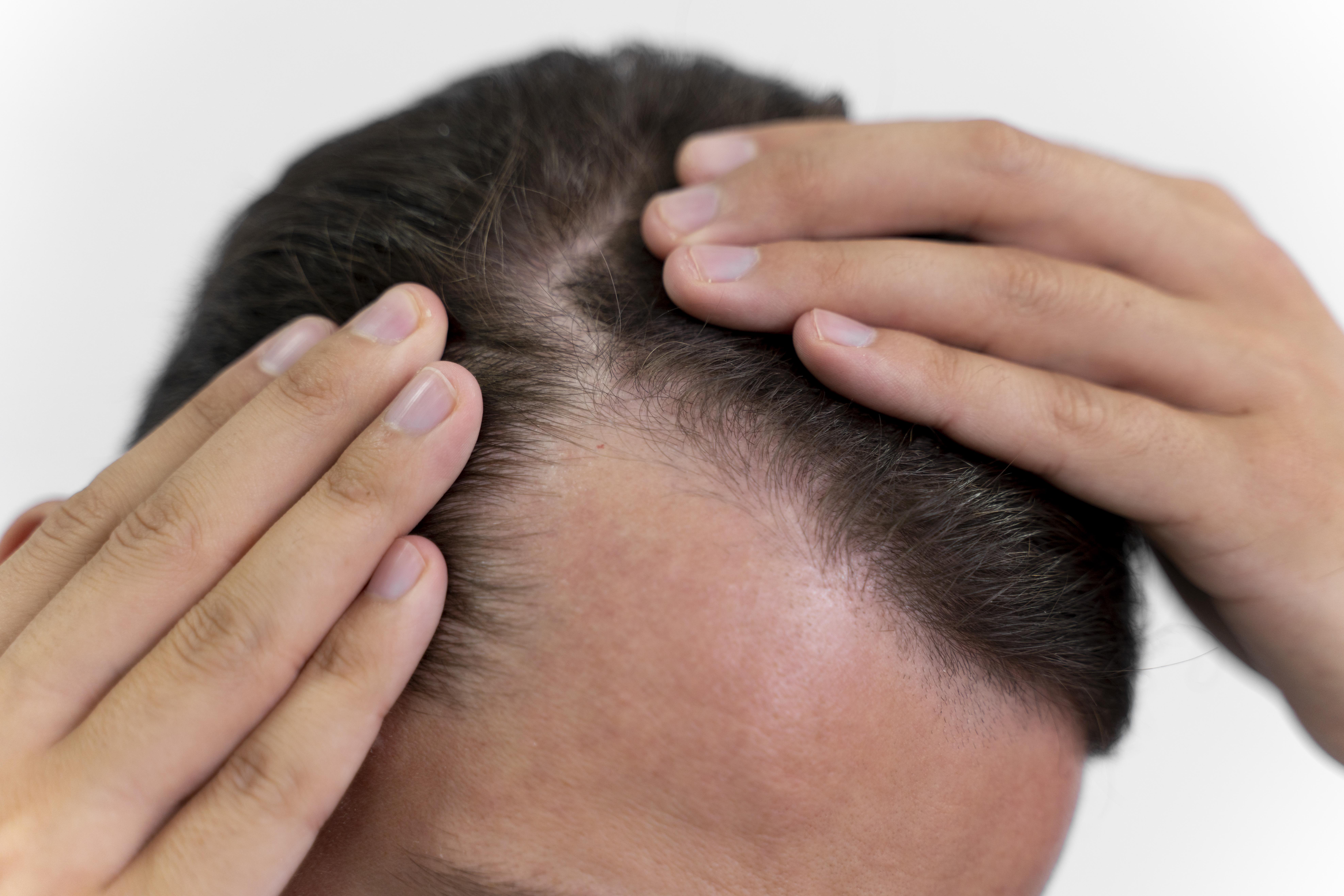 How to Get Rid Of Bald Spots - I tried it on myself!!! | البقعة الصلعاء:  سببها وكيف عالجتها - YouTube