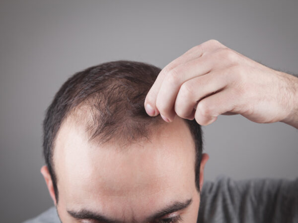 What is the relationship between Hypothyroidism and hair loss?