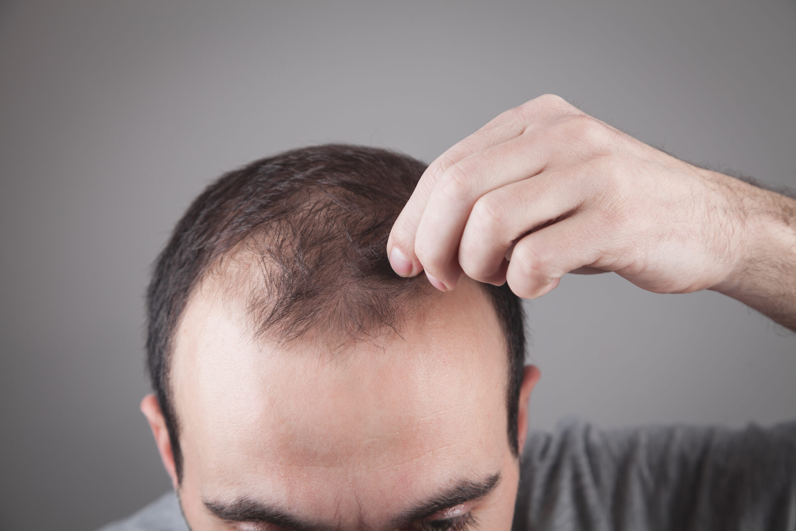 What is the relationship between Hypothyroidism and hair loss?
