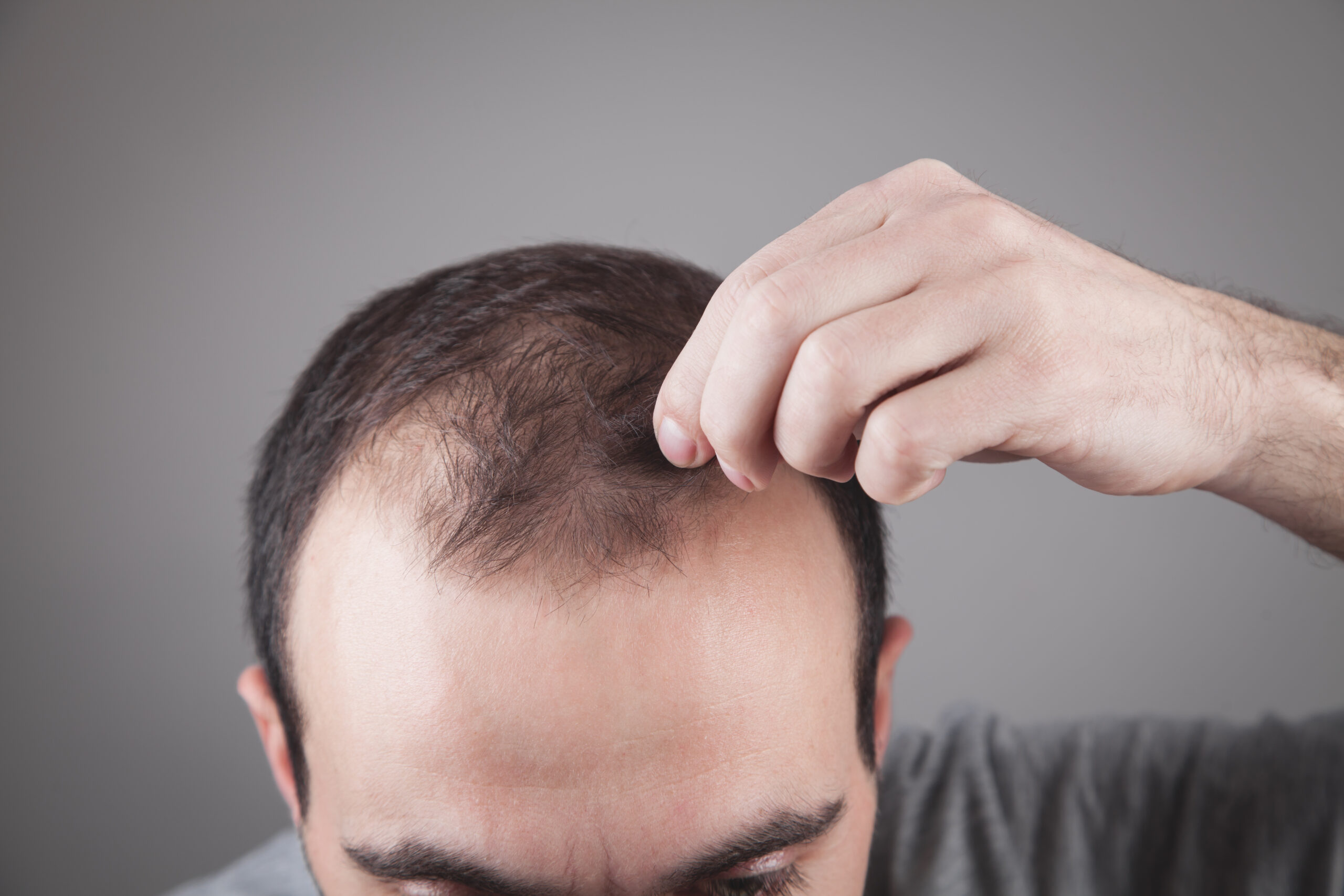 His hair. Receding Hairline. Прозрачные волосы на голове.