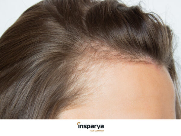 Se me cae mucho el pelo siendo joven: causas y soluciones