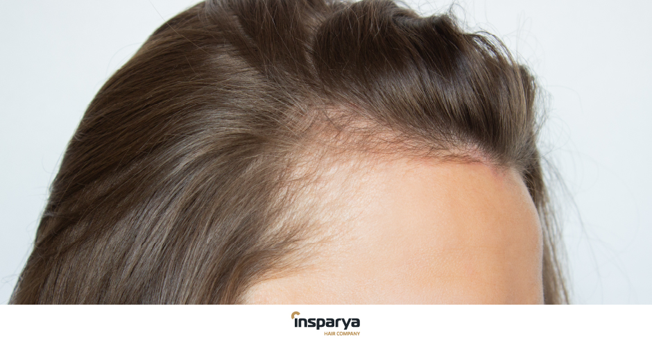 Se me cae mucho el pelo siendo joven: causas y soluciones