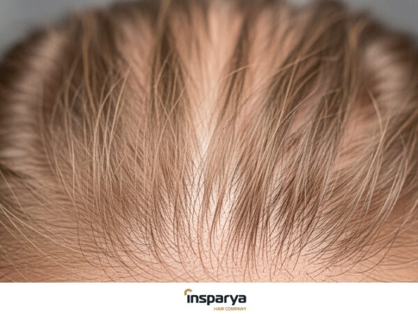 Pelo fino o pérdida de densidad: cómo diferenciarlos y qué hacer en cada caso