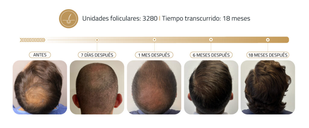 Antes y después del trasplante capilar en Insparya: resultados reales que marcan la diferencia 