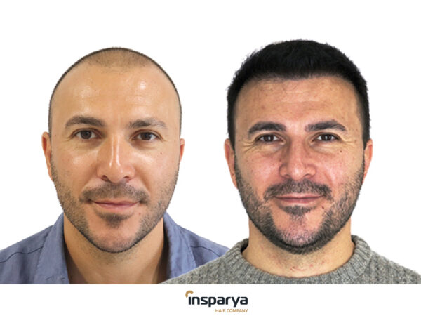 Antes y después del trasplante capilar en Insparya: resultados reales que marcan la diferencia 