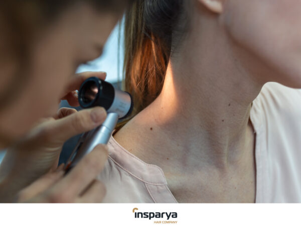 Melanoma en el cuero cabelludo: señales de alerta, prevención e impacto en la salud capilar