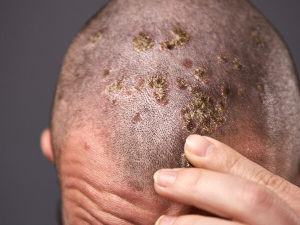 Foliculitis decalvante: cómo afrontarla y qué tratamientos pueden ayudar 